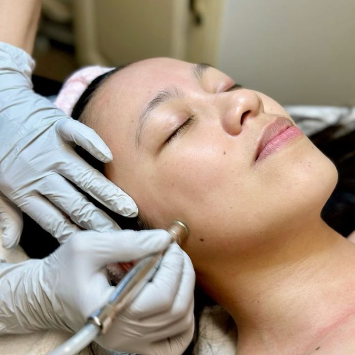 Microdermabrasion